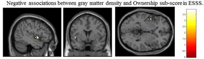 Subjectivity of the Anomalous Sense of Self Is Represented in Gray Matter Volume in the Brain